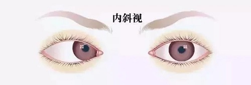 孩子眼睛有时候斜，有时候不斜，需要治疗吗？