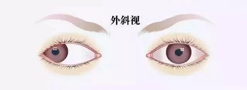 孩子眼睛有时候斜，有时候不斜，需要治疗吗？